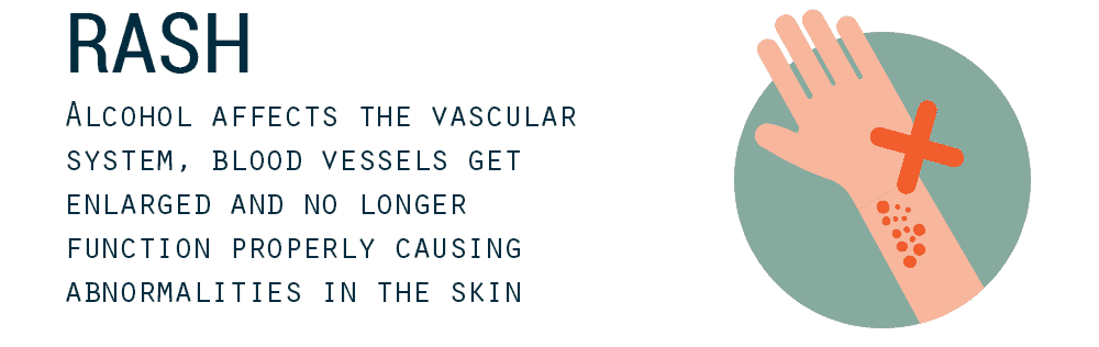 Rash