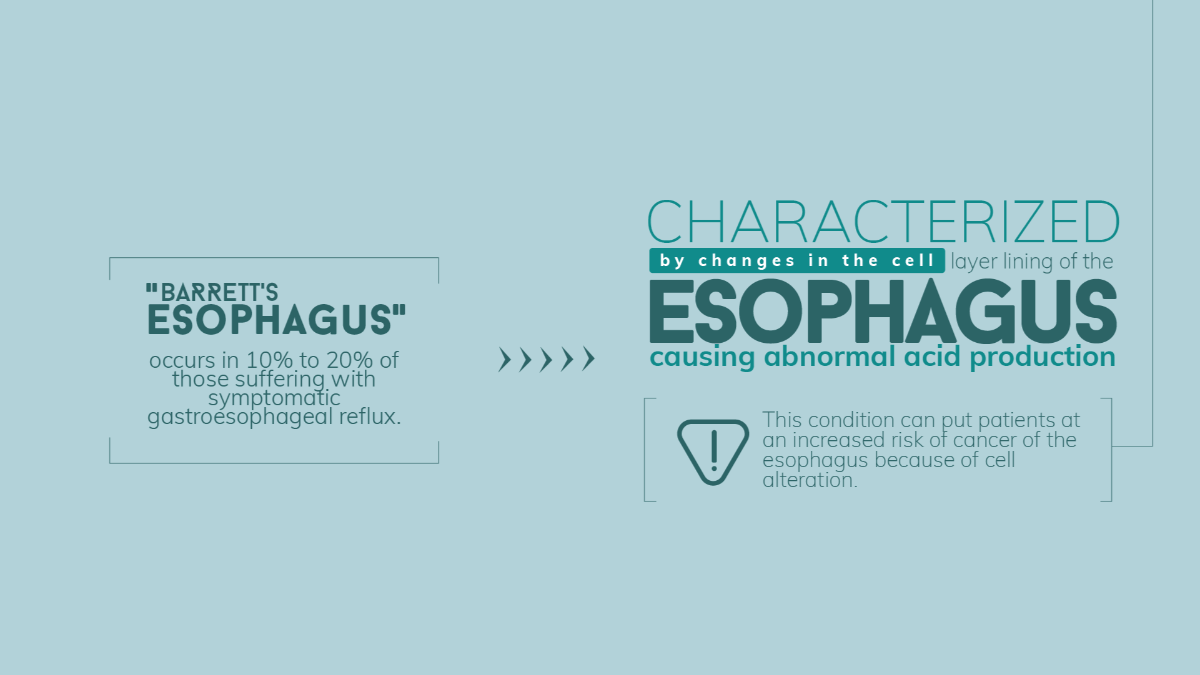 Barretts Esophagus