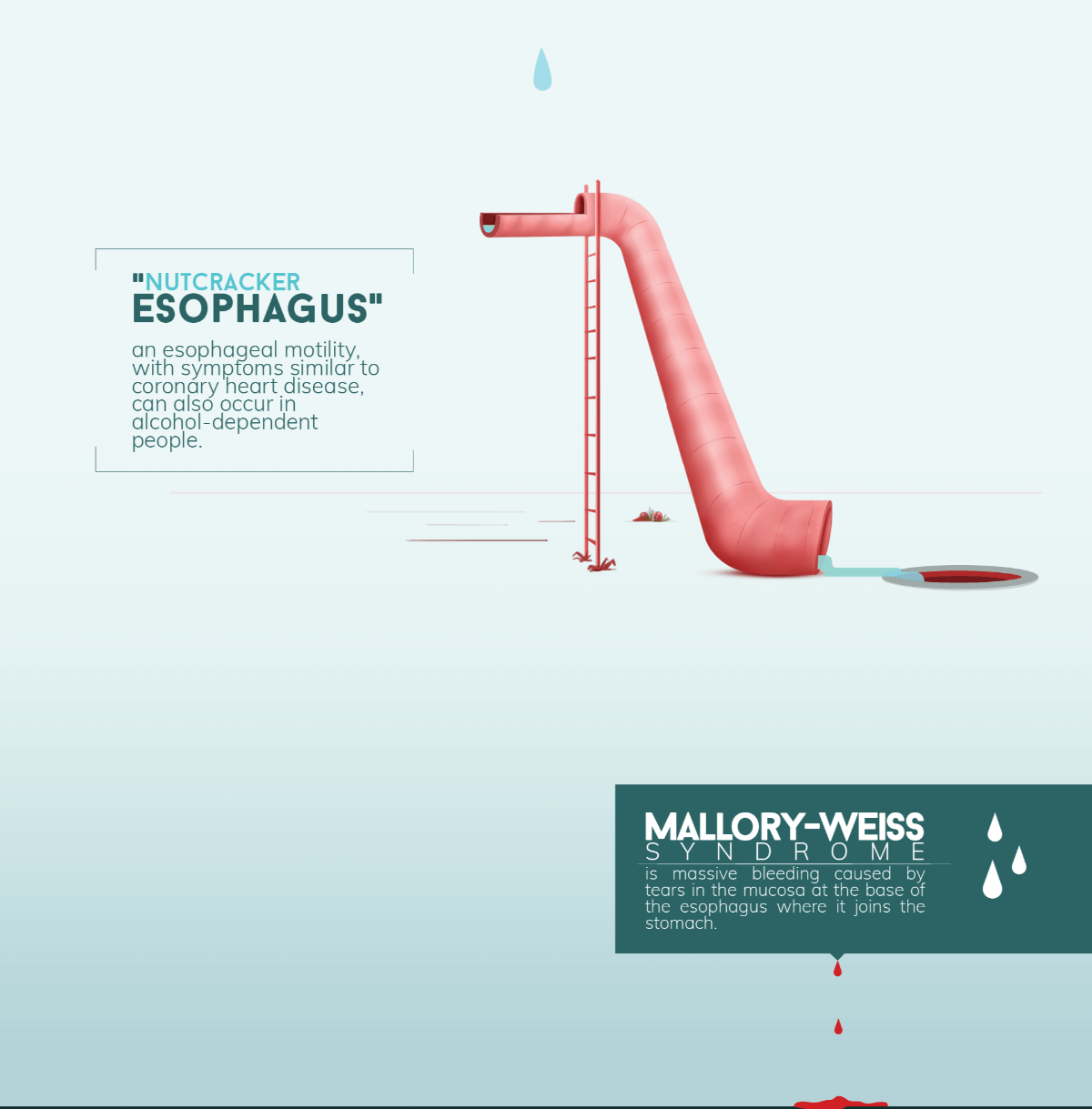 Mallory Weiss Syndrome